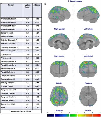 Correlation analysis between 18F-fluorodeoxyglucose positron emission tomography and cognitive function in first diagnosed Parkinson’s disease patients